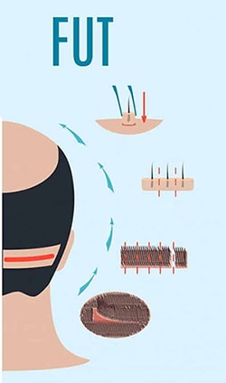 عکس گرافیکی کاشت مو به روش fut برای درمان ریزش مو